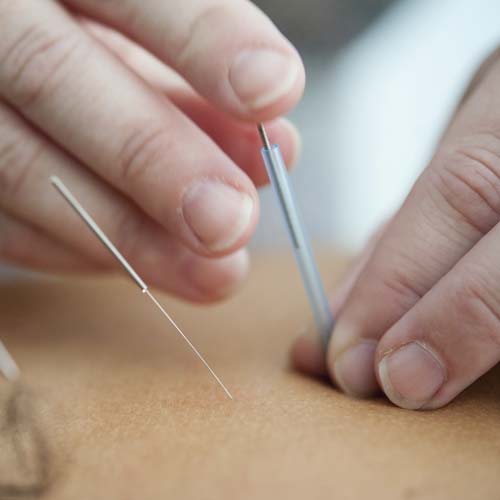 Alison Niddrie Therapist and Coaching Clinical Acupuncture